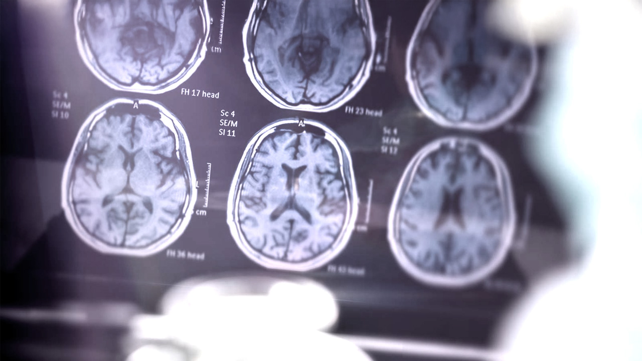 Photographie de radiologies cérébrales